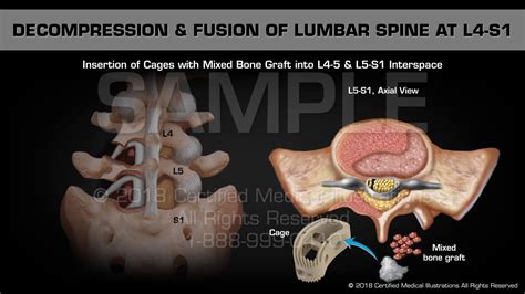 Decompression And Fusion Of Lumbar Spine At L4 S1 Youtube