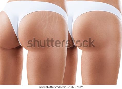 Female Buttocks Stretching Marks Before After ภาพสตอก 753707839