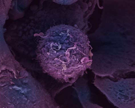 Breast Cancer Cell Wellcome Sanger Institute Blog