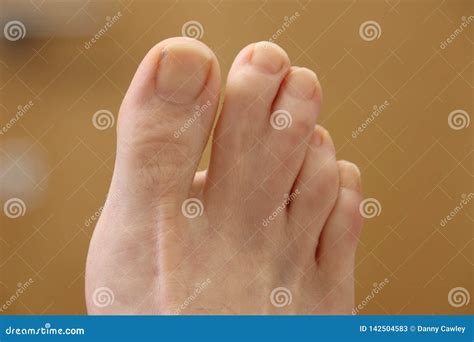 Webbed Toes On The Right Foot Stock Image Image Of Mutation