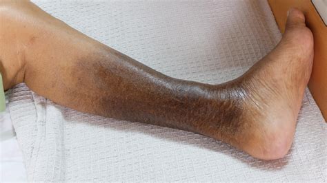 Leg Discoloration El Paso Iandi Specialists Vascular Experts 915 260 6902