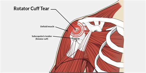 Shoulder Tendon Anatomy Diagram Rotator Cuff Injuries Complete Images