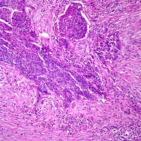Slide Show Squamous Cell Carcinoma Of The Head And Neck Cancer Network