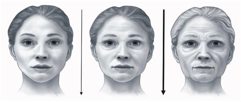 Age Related Transformation Of The Face With Volume Loss And Tissue