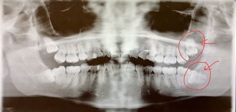 Horizontally Impacted 17 Wisdom Tooth The True Life Of A Dental