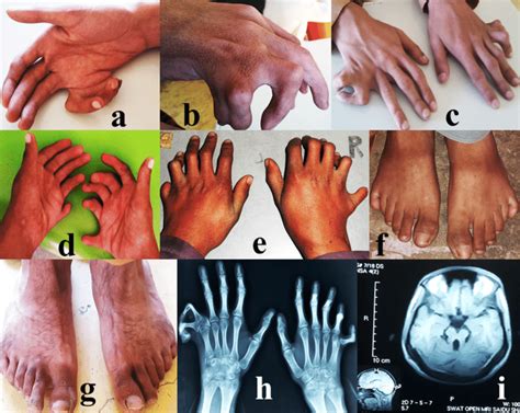 Clinical Features Of The Affected Individuals Of The Family Hand Of Download Scientific