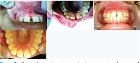 management of maxillary labial frenum and comparison between conventional techniques and