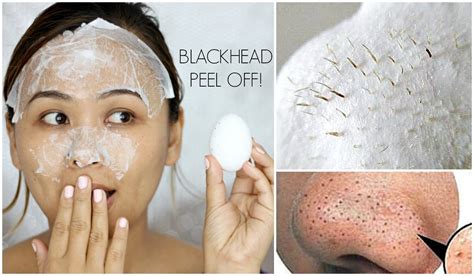 4 Home Remedies To Get Rid Of Blackheads And Acne Overnight Treatment