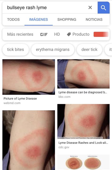Lyme Disease Skin Rash Pictures Lyme Disease Rash Symptoms Stages And
