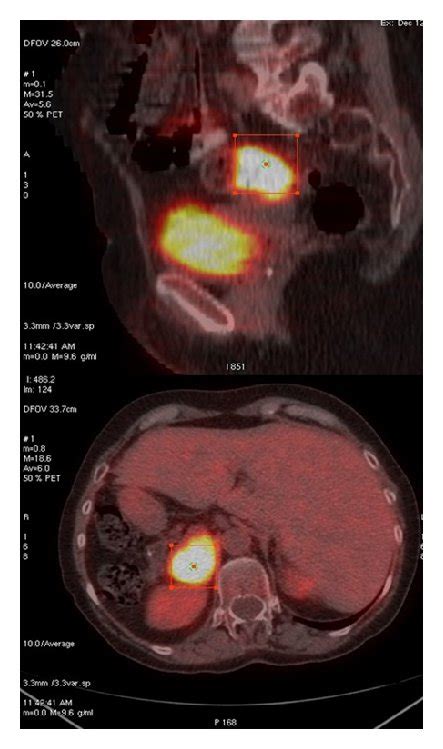 Mibg Scan Showing Increased Uptake In The Right Adrenal Gland