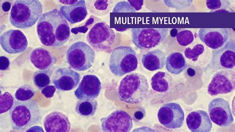 Multiple Myeloma Symptoms Causes Diagnosis And Treatment Knowinsiders