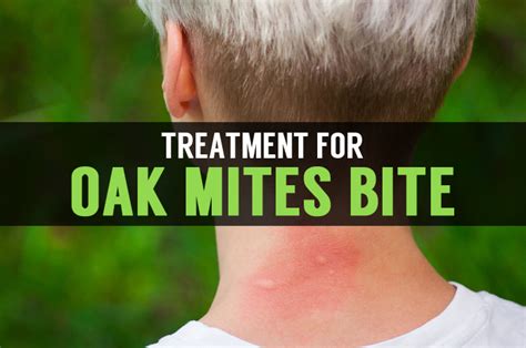 Oak Mites Treatment And Signs Of Mite Bites