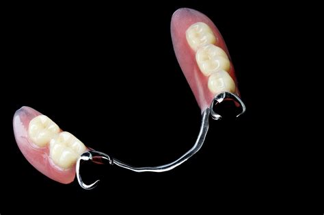 what does a flexible partial denture look like design talk