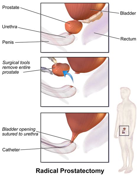 Prostatectomía Qué sucede cuando se extirpa la próstata