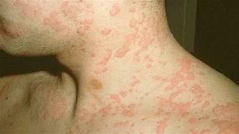Muchas Personas Creen Erróneamente Que Tienen Una Alergia Alimentaria