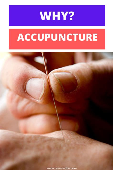 The Many Benefits Of Acupuncture Benefits Of Acupuncture Acupuncture
