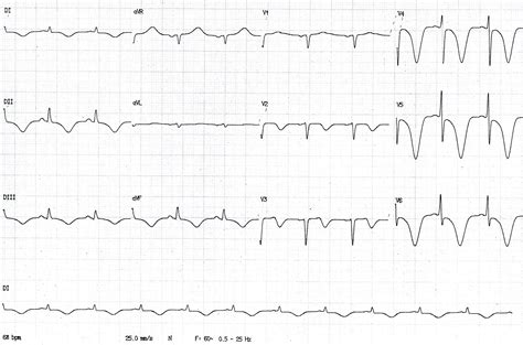 Curso básico de eletrocardiograma parte 16 Onda T CardioPapers