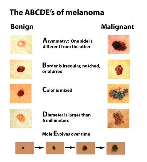 It depends on the kind of breast cancer and how far it has spread. "So I have this mole…" How to identify skin cancer and how ...