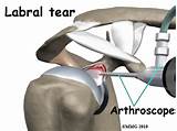 Recovery From Biceps Tenodesis Arthroscopy Surgery Images