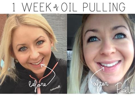 Why Im Obsessed With Oil Pulling My Remarkable Story Picklee