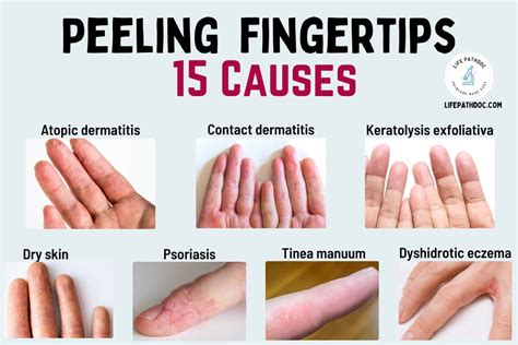 Skin Peeling On Fingertips Causes Pictures And Treatments