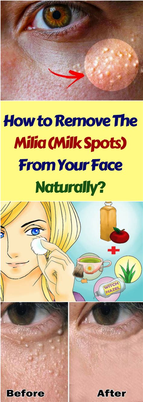 Do You Know What Milia Are Milia Is A Skin Condition Which Causes The