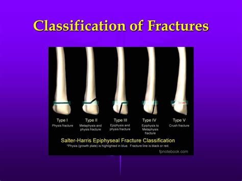 Ppt Fractures Powerpoint Presentation Free Download Id2636220