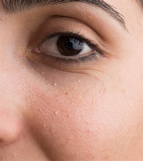 How To Get Rid Of Milia Skin Bumps White Bumps On Face Bumpy Skin