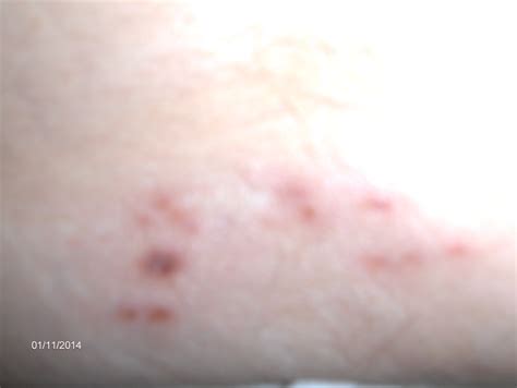 Pain In The Hip Blisters Rash Shingles Walk In Clinic Orlando Urgent