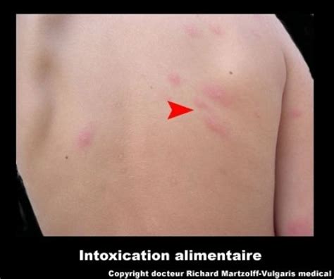 Image Photo Intoxication Alimentaire Infectieux Et Parasitologie