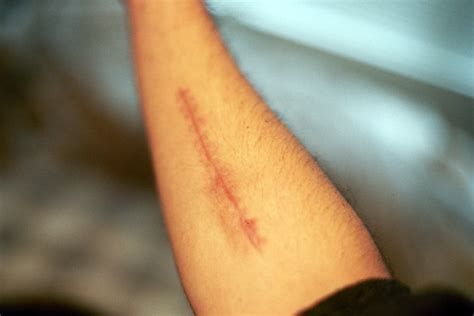 Scar Broken Bruised Forgotten Sore Very Broken Arm Flickr