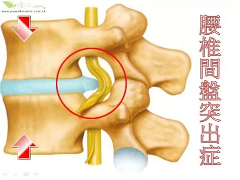 復健科吳韋廷醫師增生治療plus增生療法 門診常見的腰痛背痛 腰椎間盤突出