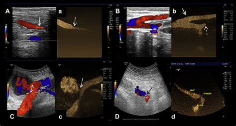 B Flow Imaging In Lower Limb Peripheral Arterial Disease And Bypass