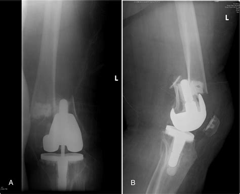 High Complication Rate In Locking Plate Fixation Of Lower