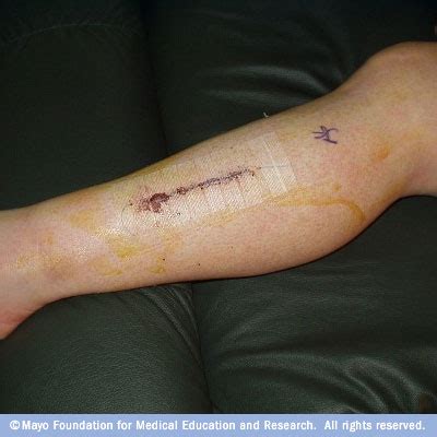 Chronic Chronic Compartment Syndrome