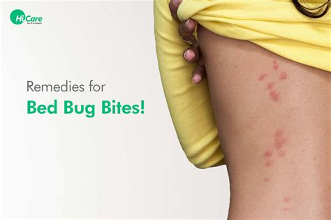Top Bed Bug Bites Treatment Hicare