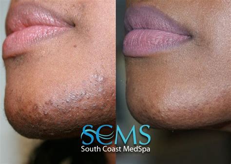 Excessive facial hair growth is a concern for many women. Pin on Laser Hair Removal