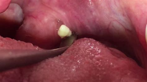 Tonsil Stone Removal 11 Youtube