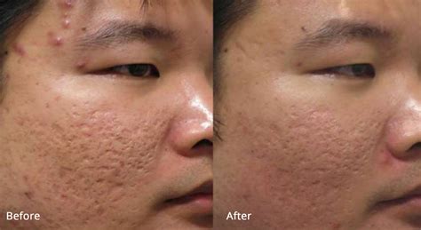 Richmond Hill Natural Therapies Microneedling With Fractora