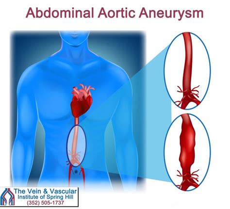 Abdominal Aortic Aneurysm Repair Spring Hill Fl Abdominal Aortic