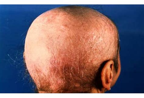 Cutaneous Fungal Infections Slideshow