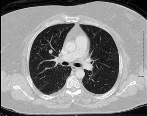 Metastasis In Lung Ct Scan Stock Image C0393379 Science Photo