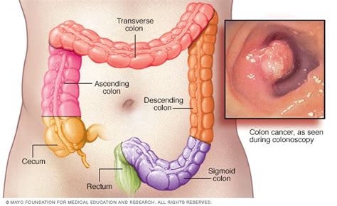 Overview Colon Cancer Mayo Clinic
