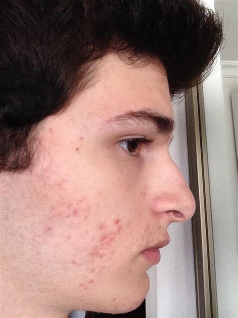Acne My Acne Wont Go Away Long Detailed Post With Questions That