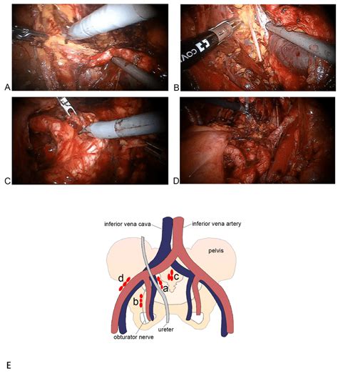 Extended Pelvic Lymph Node Dissection E Plnd A External Iliac