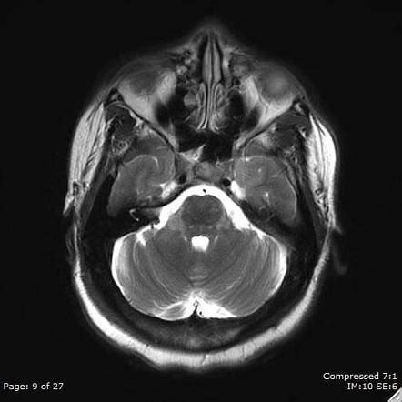Clippers syndrome (chronic lymphocytic inflammation with pontine perivascular enhancement responsive to steroids) is a recently described rare disease affecting the central nervous system. Chronic lymphocytic inflammation with pontine perivascular ...