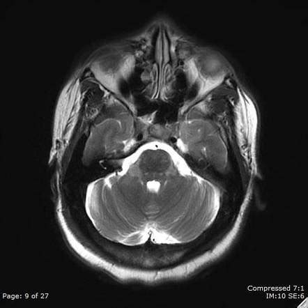 Die erkrankung geht mit charakteristischen. Chronic lymphocytic inflammation with pontine perivascular ...