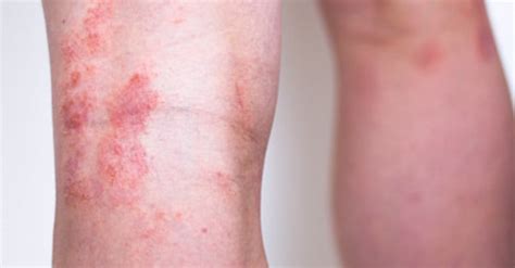 Psoriasis Skin Disease Causes Symptoms And Treatments Premier Clinic