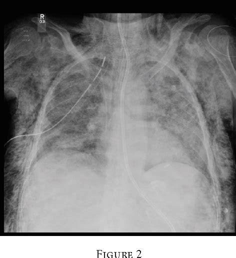 Figure 2 From Tension Pneumothorax And Subcutaneous Emphysema