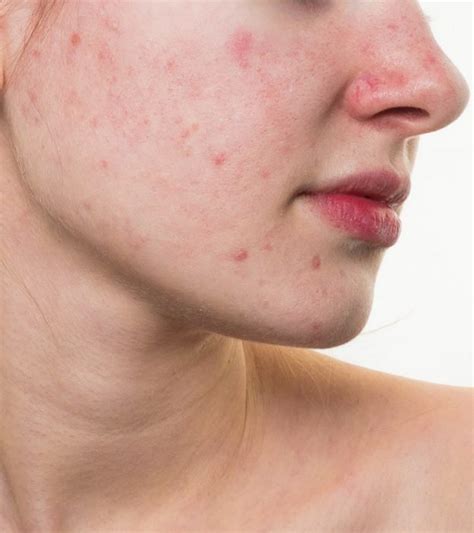 Does Eczema Cause Discoloration Of The Skin Sanchez Yousight